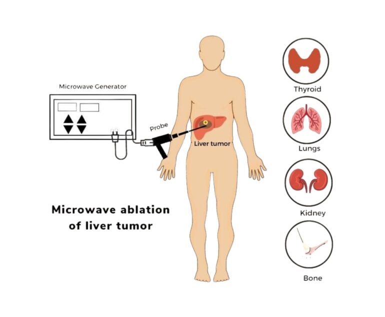 Interventional Oncology microwave ablation dr rakesh kumawat vascular and interventional radiologist