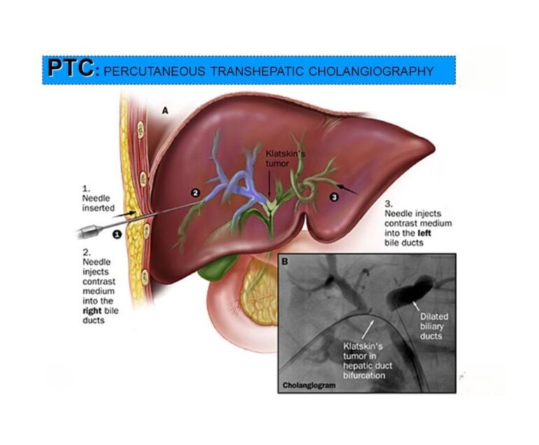 ptbd oncology dr rakesh kumawat vascular and interventional radiologist