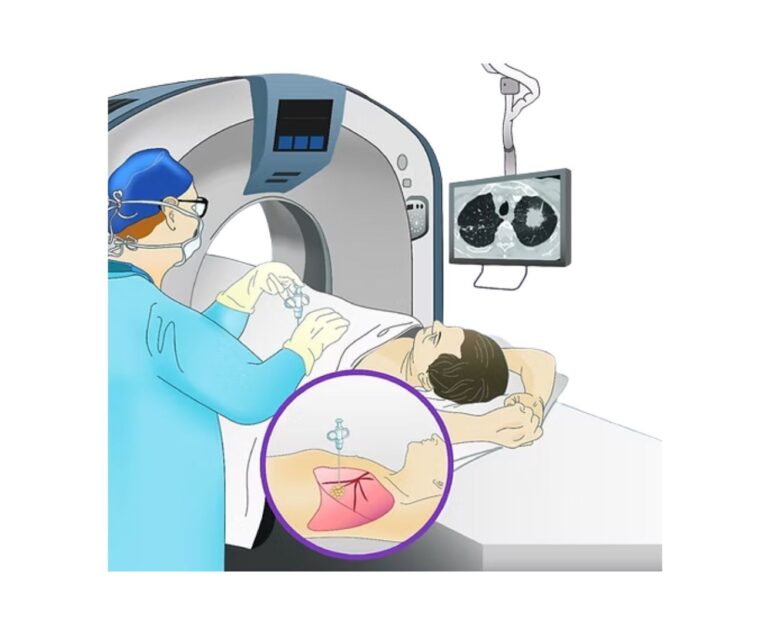 CT GUIDED Biopsy dr rakesh kumawat vascular and interventional radiologist