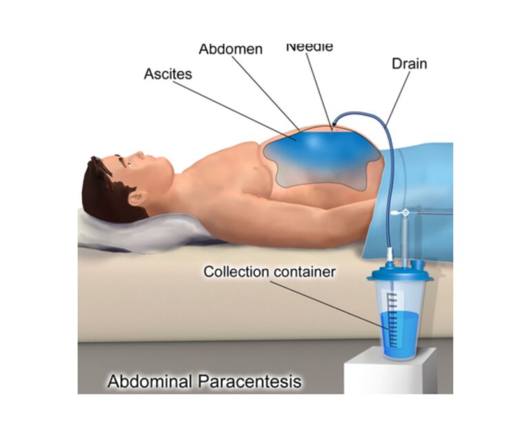 Drainage Catheter Placement dr rakesh kumawat vascular and interventional radiologist