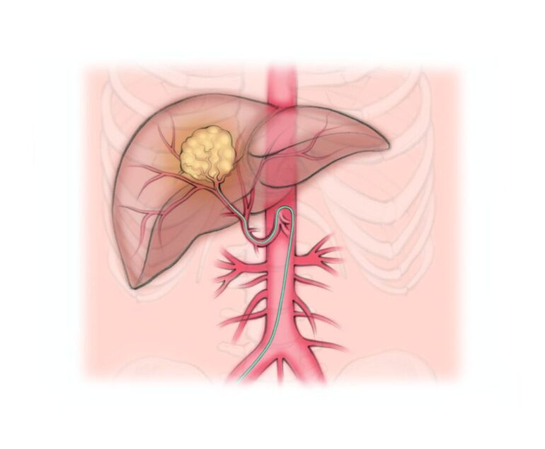 Interventional Oncology TARE dr rakesh kumawat vascular and interventional radiologist