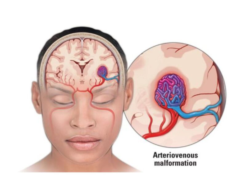 Neurointerventions AVM Embolization dr rakesh kumawat vascular and interventional radiologist