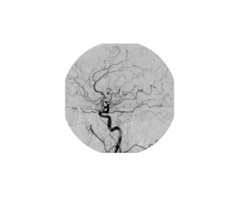 Neurointerventions Digital Subtraction Angiography (DSA) dr rakesh kumawat vascular and interventional radiologist