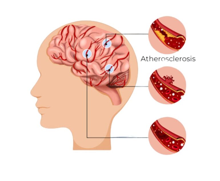 Neurointerventions Mechanical Thrombectomy dr rakesh kumawat vascular and interventional radiologist