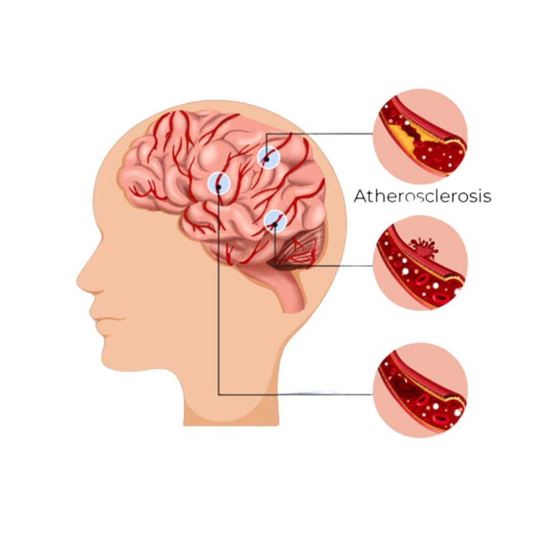 Neurointerventions Mechanical Thrombectomy dr rakesh kumawat vascular and interventional radiologist