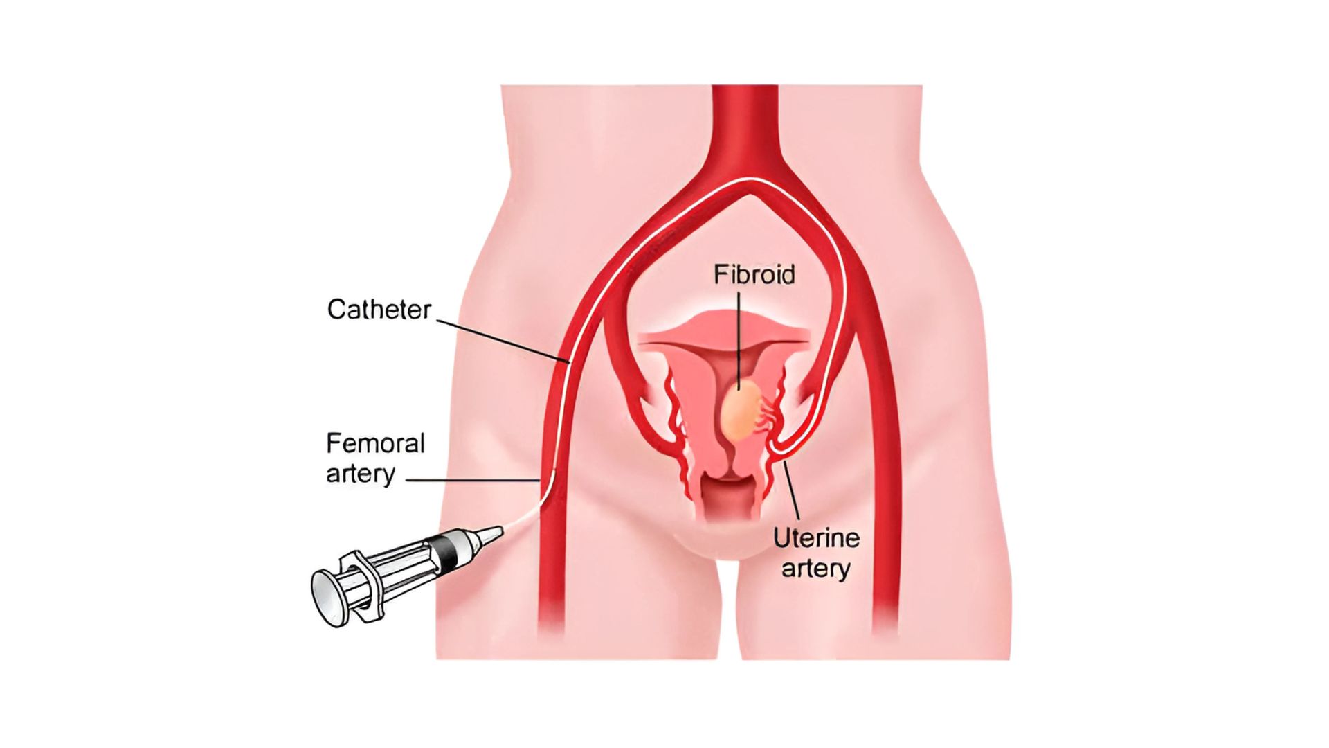 Obs & Gynaecologist UAE dr rakesh kumawat vascular and interventional radiologist