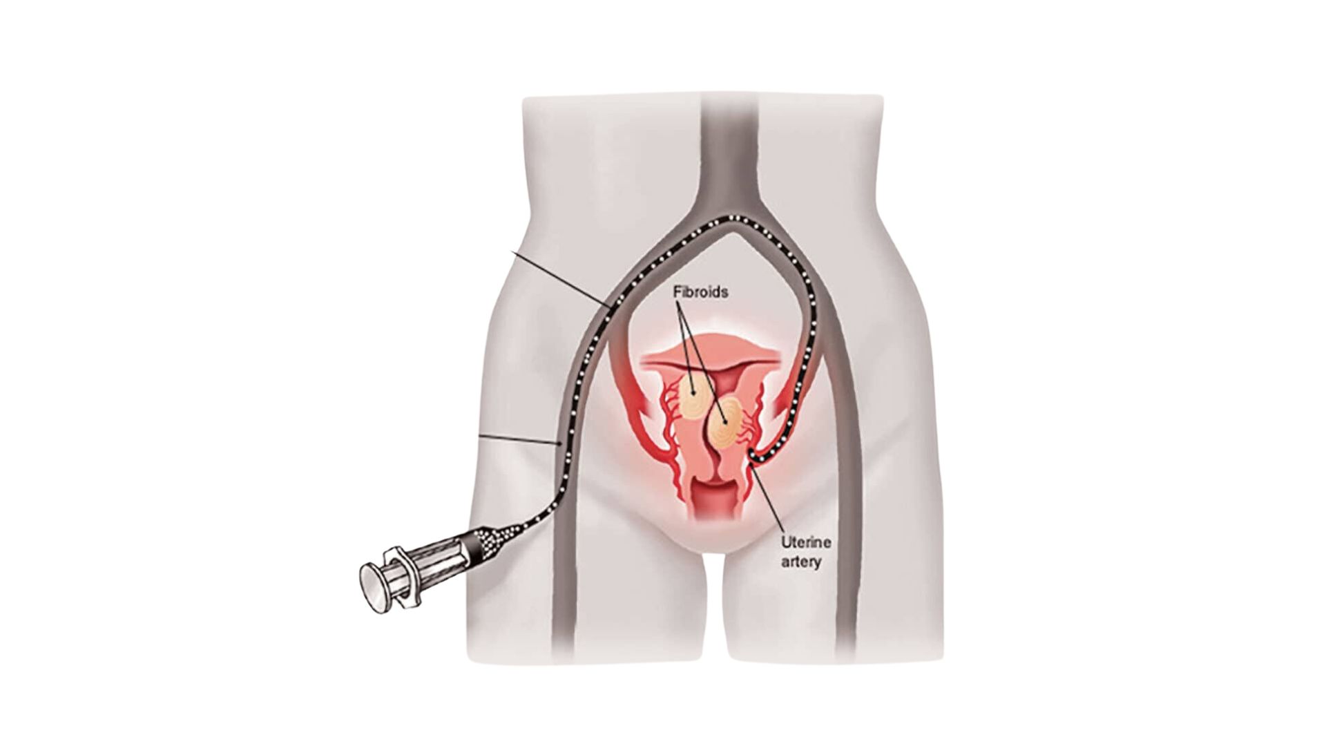 Obs & Gynaecologist Uterine Fibroid Embolization (UFE) dr rakesh kumawat vascular and interventional radiologist