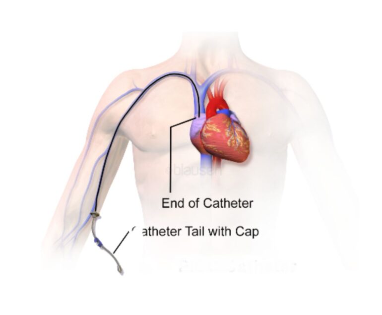 Picc Line Placement dr rakesh kumawat vascular and interventional radiologist