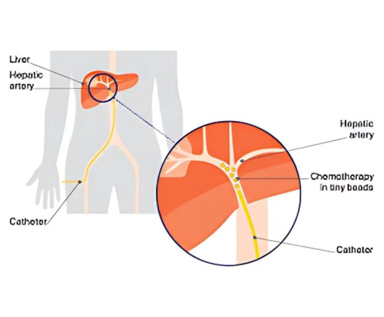 TACE dr rakesh kumawat vascular and interventional radiologist