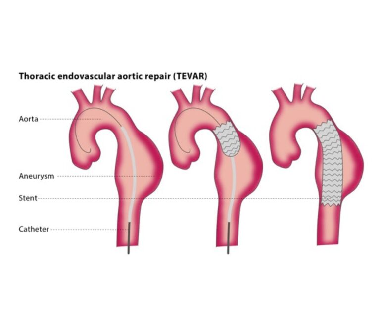 TEVAR dr rakesh kumawat vascular and interventional radiologist