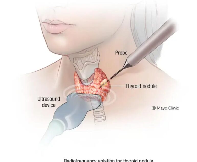 THYROID NODULE dr rakesh kumawat vascular and interventional radiologist