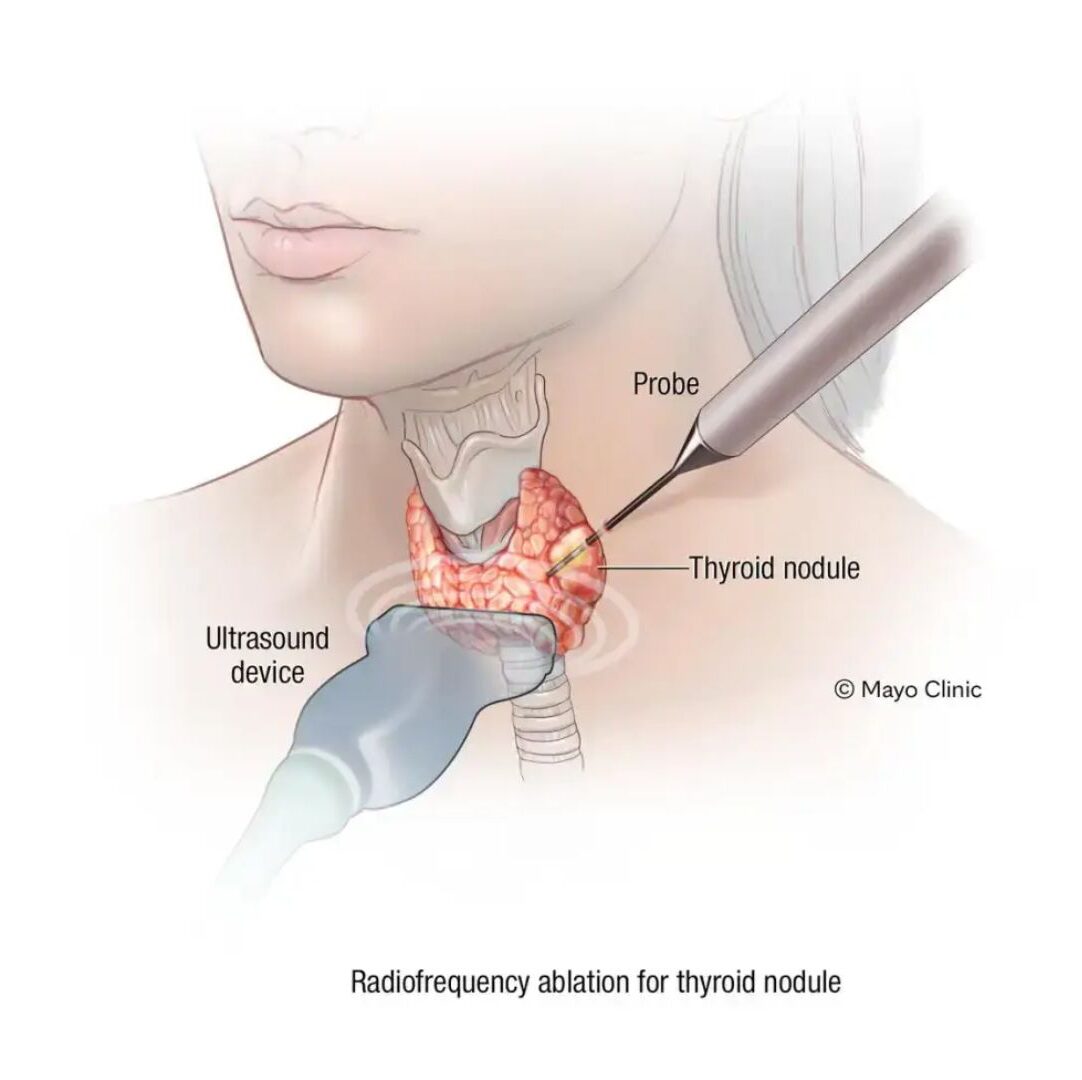 THYROID NODULE dr rakesh kumawat vascular and interventional radiologist