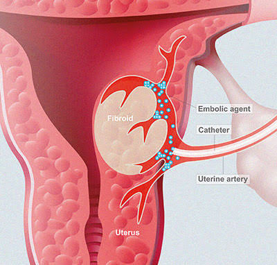 Uterine Fibroids Embolisation