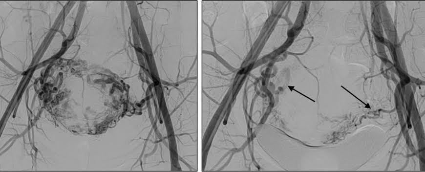 Uterine Fibroid Embolization