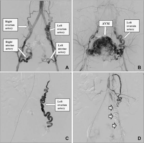 Uterine arteriovenous malformation