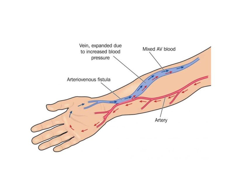 Vascular Arterial And Venous AV Fistuloplasty dr rakesh kumawat vascular and interventional radiologist