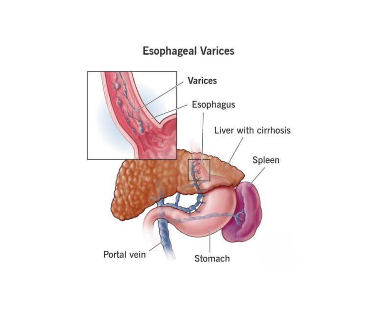 Vascular Arterial And Venous Liver Cirrhosis and PHT dr rakesh kumawat vascular and interventional radiologist