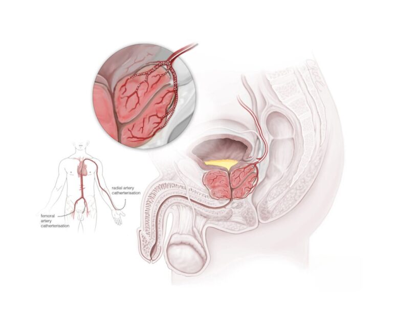 Vascular Arterial And Venous Prostatic Artery Embolization (PAE) Treatment dr rakesh kumawat vascular and interventional radiologist