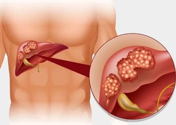 liver-tumour dr rakesh kumawat vascular and interventional radiologist