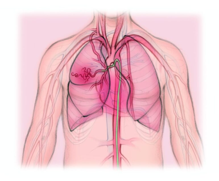 vascular artery Bronchial Artery Embolization dr rakesh kumawat vascular and interventional radiologist