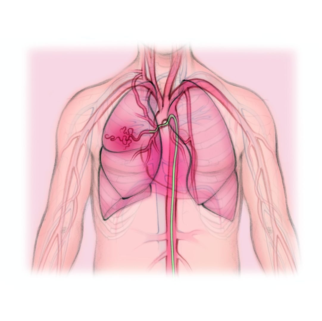 vascular artery Bronchial Artery Embolization dr rakesh kumawat vascular and interventional radiologist