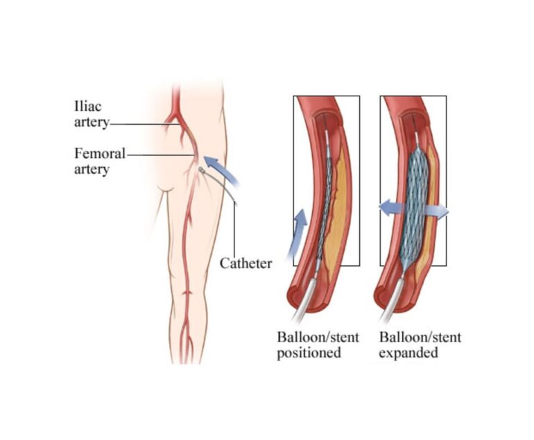 vascular artery Peripheral Angiography_ Angioplasty dr rakesh kumawat vascular and interventional radiologist