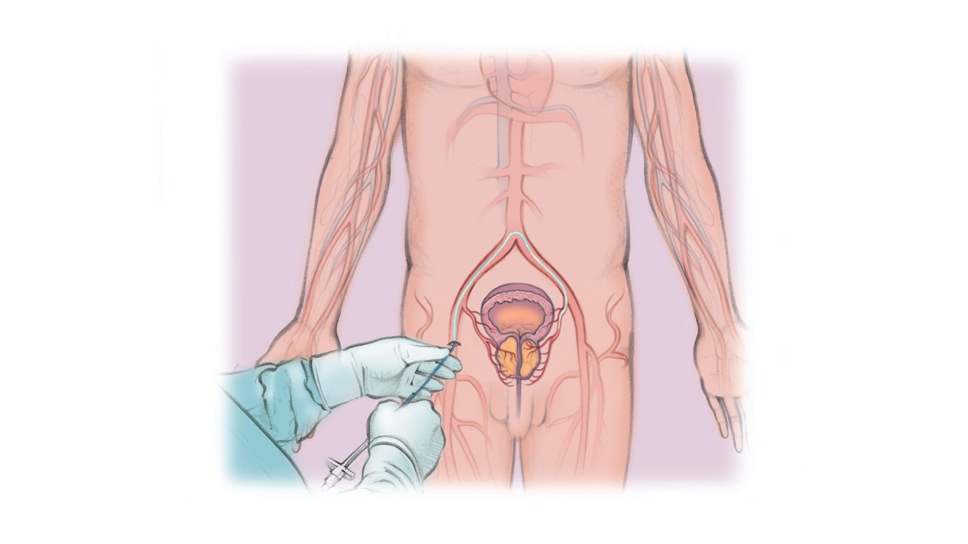 vascular artery Prostatic Artery Embolization (PAE) dr rakesh kumawat vascular and interventional radiologist