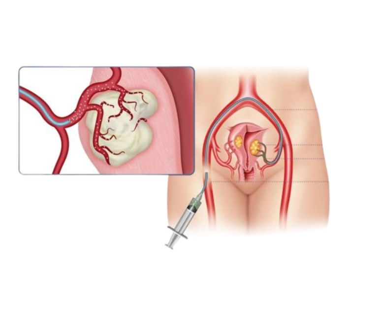 vascular artery UAE dr rakesh kumawat vascular and interventional radiologist