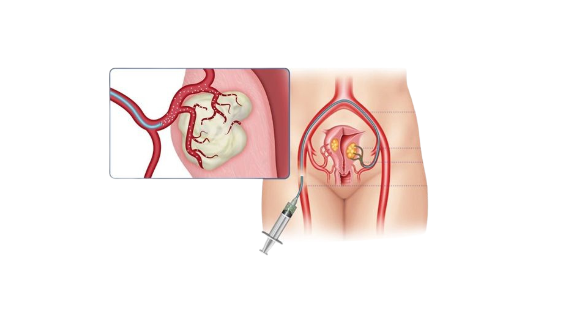 vascular artery UAE dr rakesh kumawat vascular and interventional radiologist