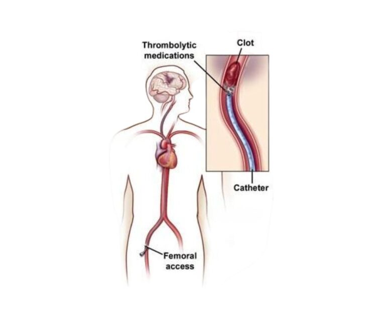 vascular arteryDVT (catheter directed thrombolysis_thrombectomy) dr rakesh kumawat vascular and interventional radiologist