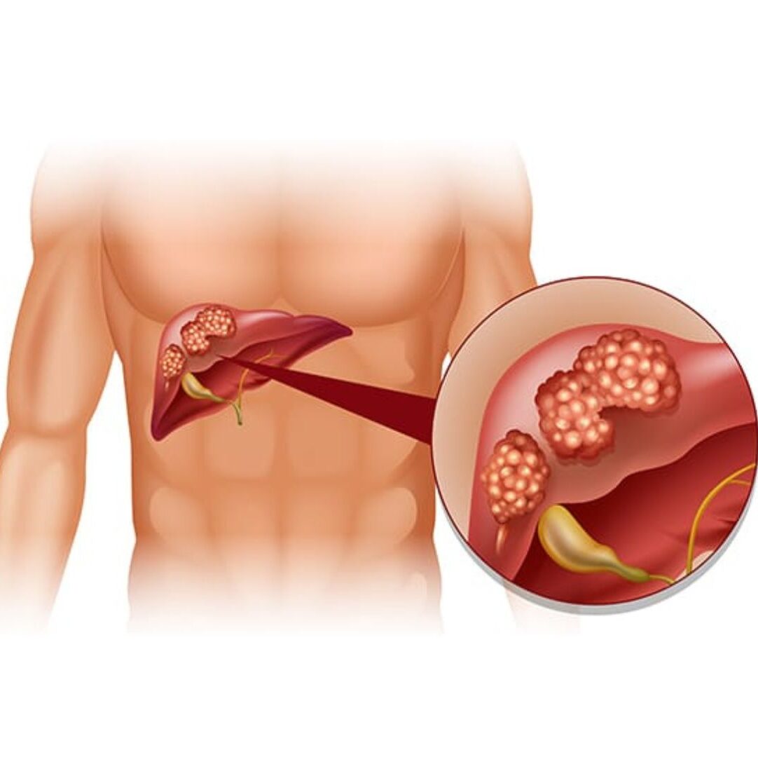 Interventional Oncology Home dr rakesh kumawat vascular and interventional radiologist