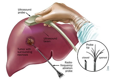 Tumor-Ablation (1) dr rakesh kumawat vascular and interventional radiologist